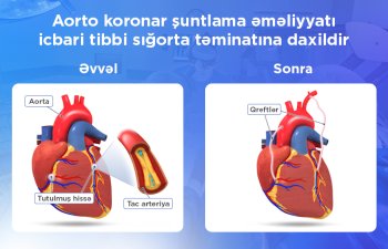 Aorto-koronar şuntlama əməliyyatı icbari tibbi sığorta ilə qarşılanır