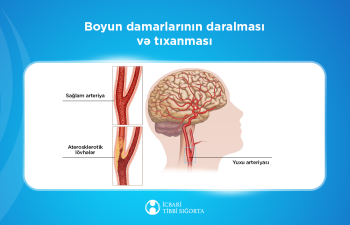 İcbarı tibbi sığorta ilə beyin qan dövranı pozulmalarının müalicəsi artıq mümkündür